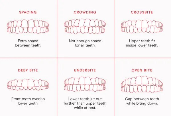 Candid Pro Clear Aligners Vancouver WA | Different Than Other Clear ...